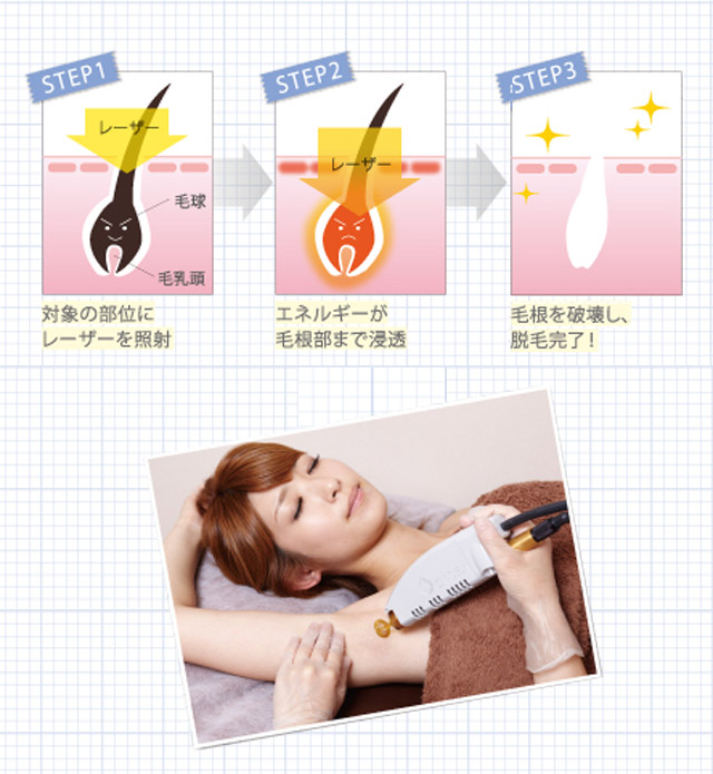 医療レーザー脱毛の仕組み