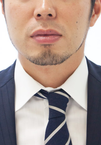 「全体的に薄く」も「部分的に脱毛」も自由自在