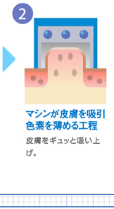 マシンが皮膚を吸引 色素を薄める工程
