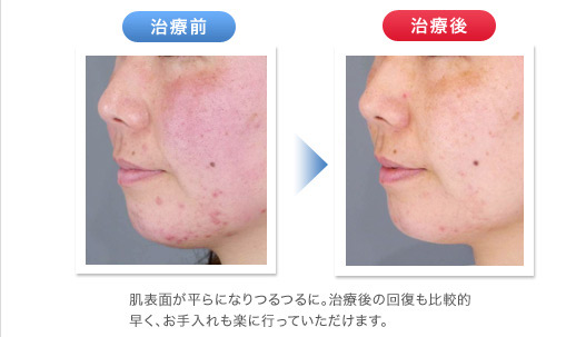 治療前→治療後 肌表面が平らになりつるつるに。治療後の回復も比較的早く、お手入れも楽に行っていただけます。