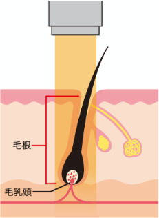 医療脱毛イメージ