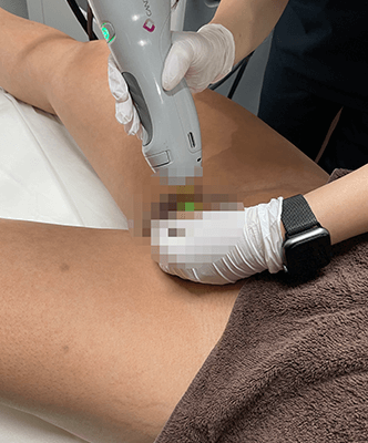 男性器を脱毛している施術シーン