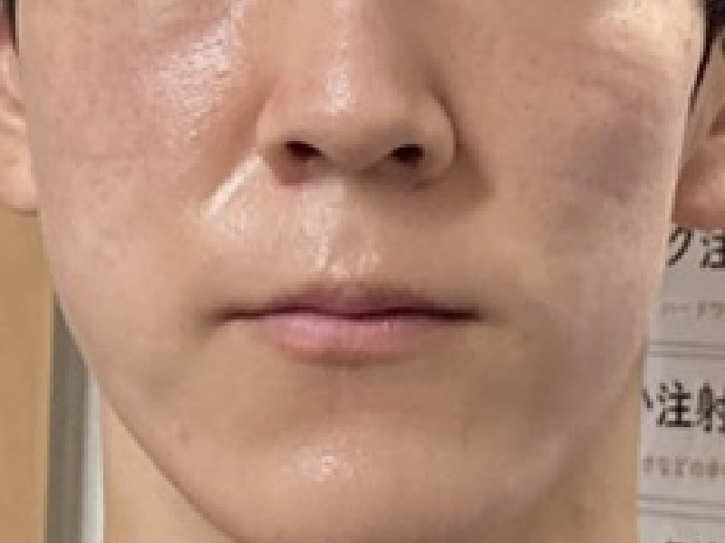 当院のレーザーフェイシャル治療の結果