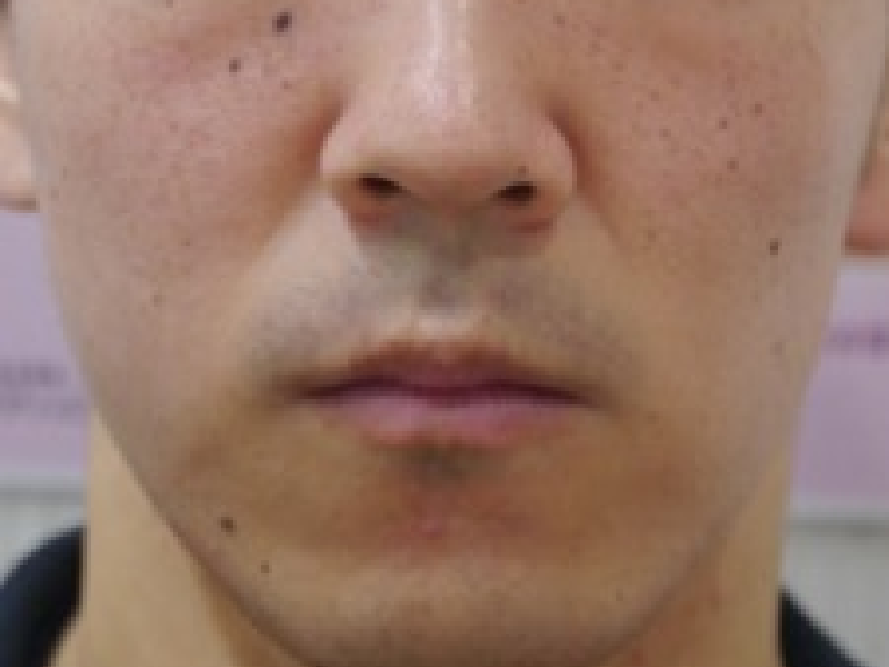 当院のレーザーフェイシャル治療の結果