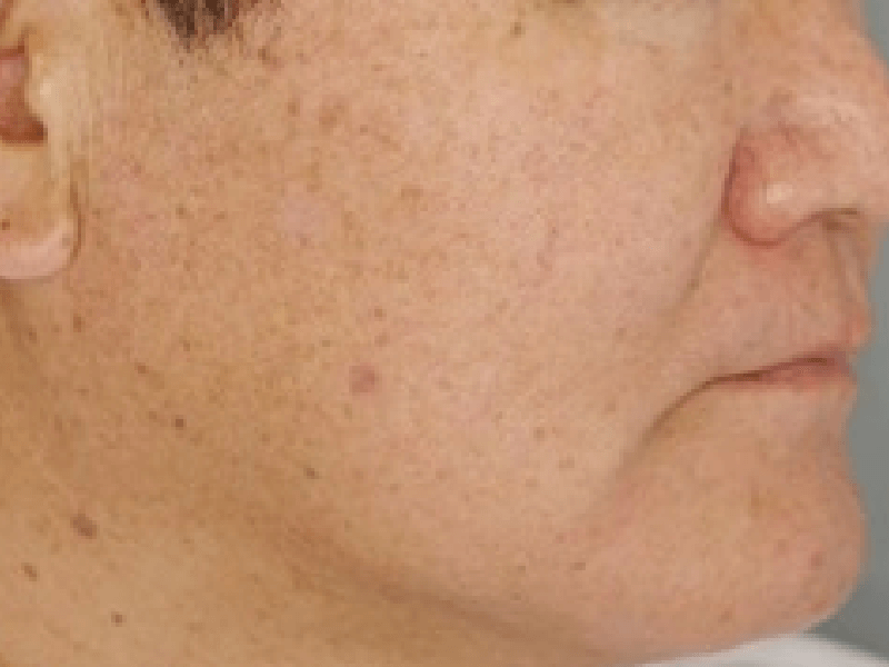 当院のレーザーフェイシャル治療の結果