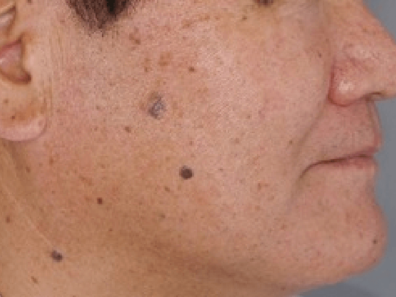 当院のレーザーフェイシャル治療の結果