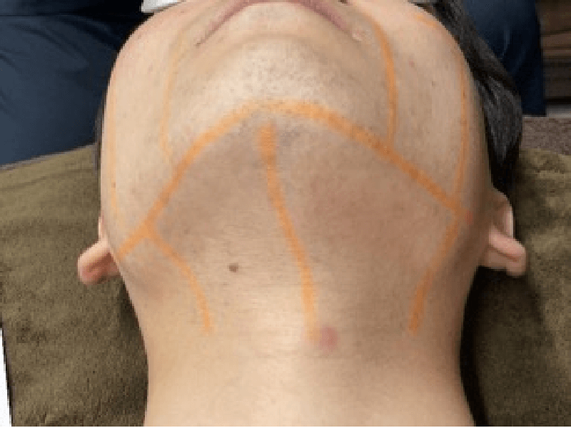 当院のレーザーフェイシャル治療の結果