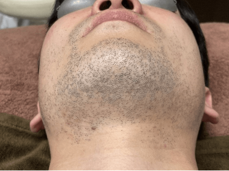 当院のレーザーフェイシャル治療の結果