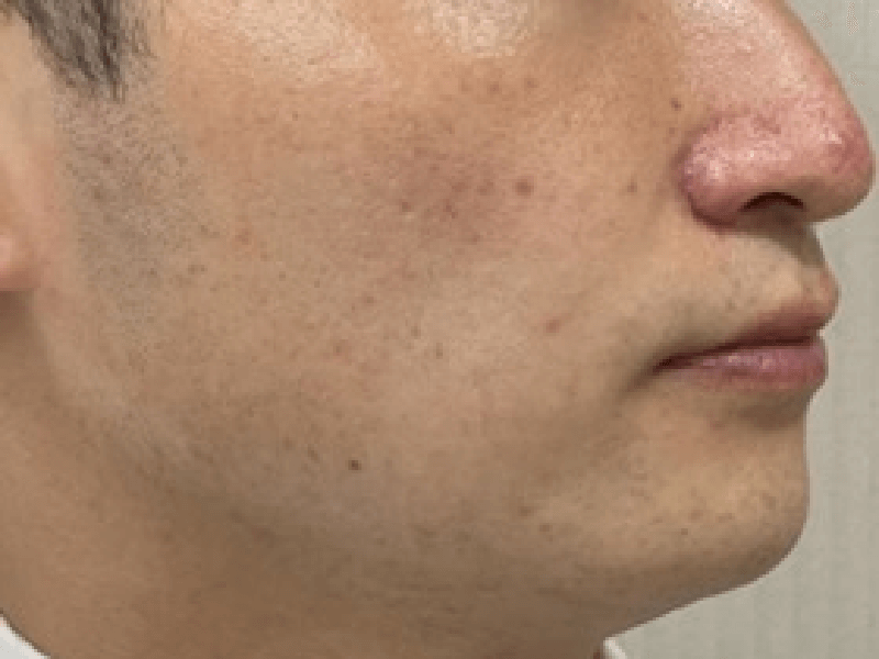 当院のレーザーフェイシャル治療の結果