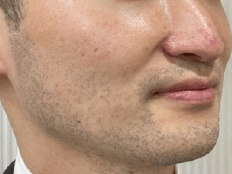 当院のレーザーフェイシャル治療の結果